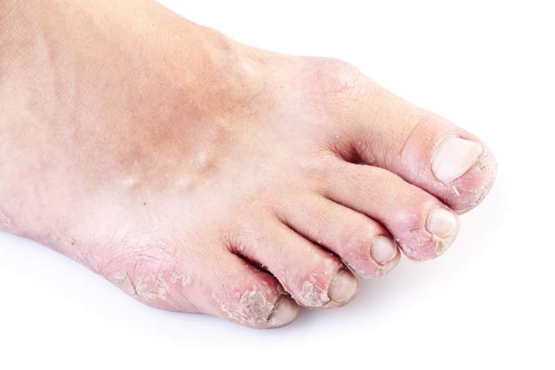 Food eczema