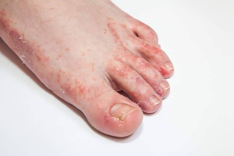 Dermatitis and crustiness