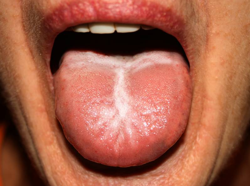 Itchy tongue due to yeast infection 
