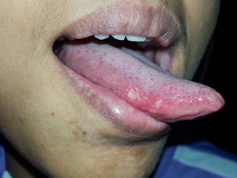 Canker sore on side of the tongue