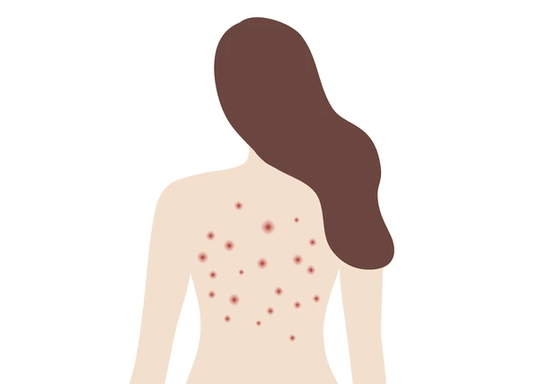 back acne