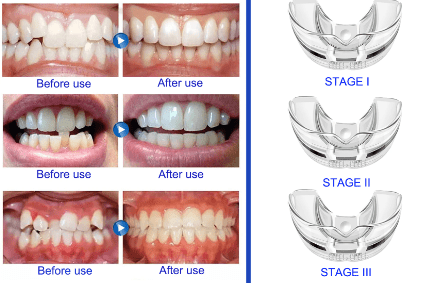 Orthodontic Braces Dental Teeth Aligners Cheap