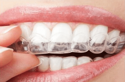 Silicone Gel Invisalign Hygiene Dental Teeth Aligners Cheap